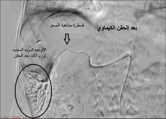 مستشفي سوهاج الجامعي تجري أول حالة قسطرة علاجية لأورام الكبد