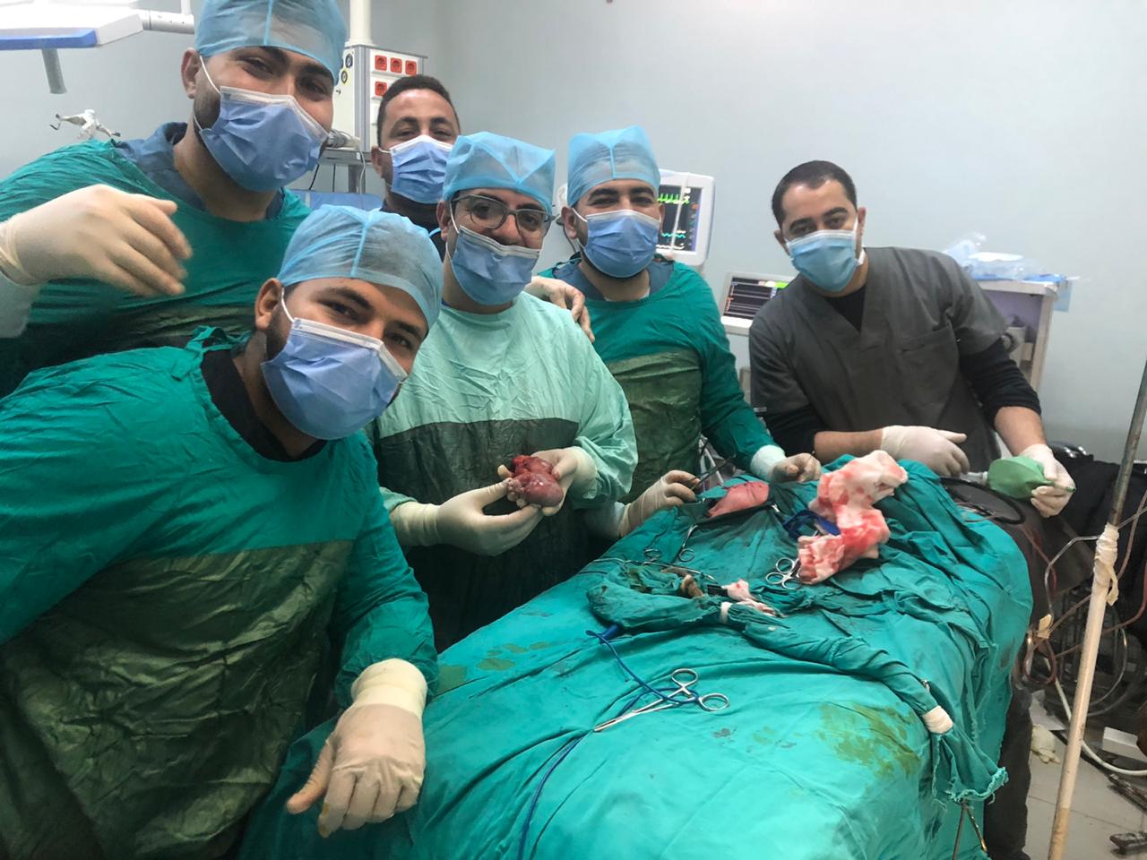 جراحة نادرة بمستشفيات جامعة المنيا لاستئصال توأم مسخي ملتصق لطفلة في أسبوعها الأول