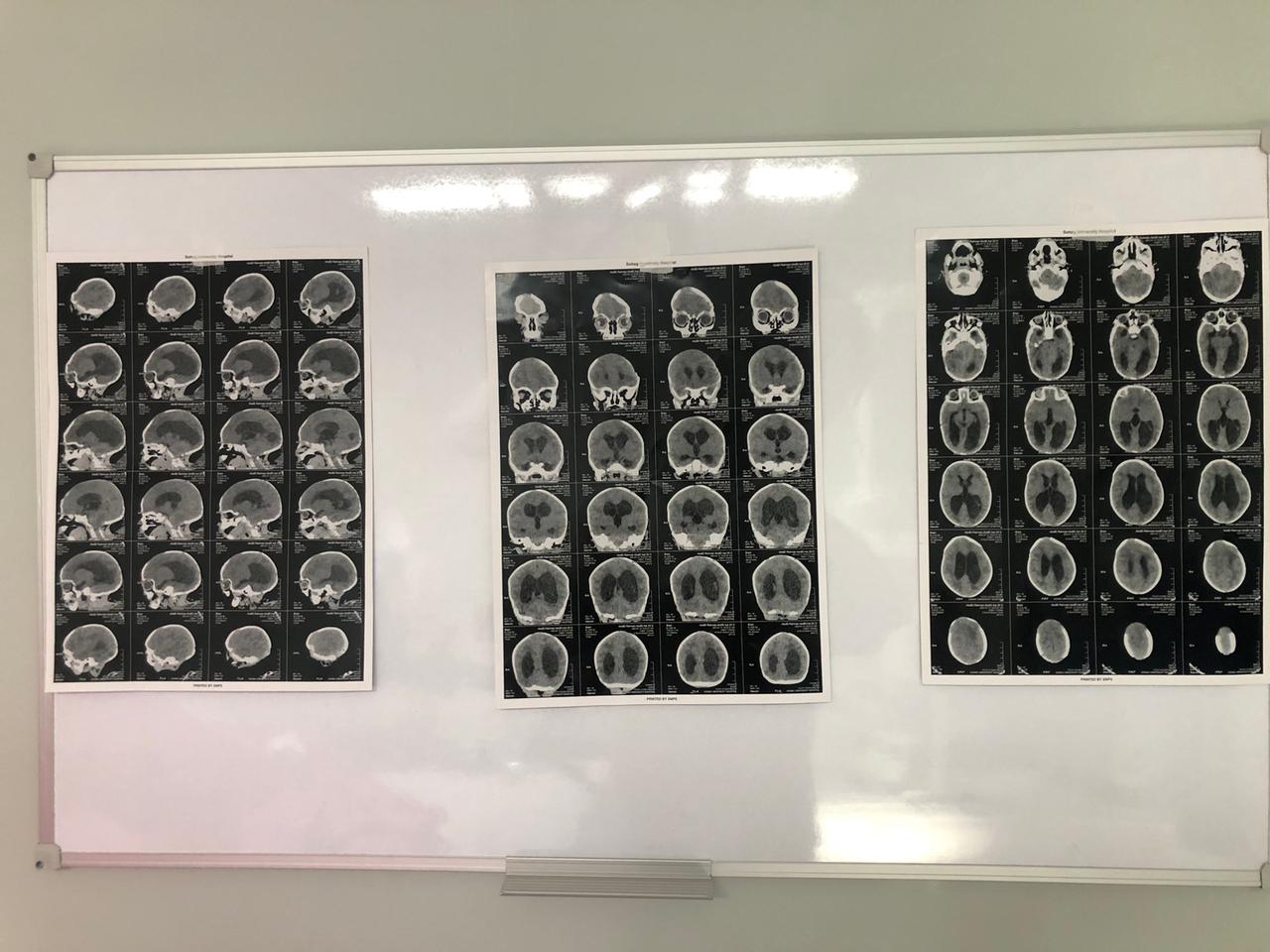 جامعة سوهاج: إجراء أول التداخلات الجراحية الميكروسكوبية للمخ والأعصاب بالمستشفى الجامعي الجديد